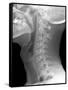 Normal Neck, X-ray-Du Cane Medical-Framed Stretched Canvas