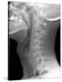 Normal Neck, X-ray-Du Cane Medical-Stretched Canvas