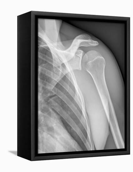 Normal Shoulder, X-ray-ZEPHYR-Framed Stretched Canvas