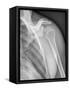 Normal Shoulder, X-ray-ZEPHYR-Framed Stretched Canvas