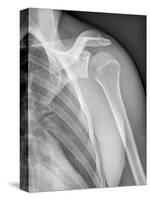 Normal Shoulder, X-ray-ZEPHYR-Stretched Canvas