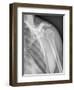 Normal Shoulder, X-ray-ZEPHYR-Framed Photographic Print