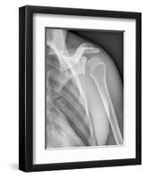 Normal Shoulder, X-ray-ZEPHYR-Framed Photographic Print