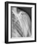 Normal Shoulder, X-ray-ZEPHYR-Framed Photographic Print