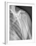 Normal Shoulder, X-ray-ZEPHYR-Framed Photographic Print