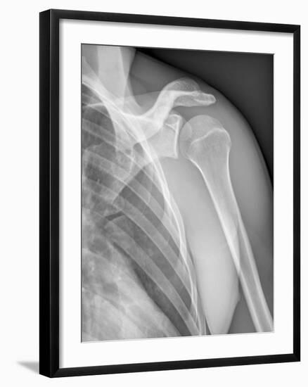 Normal Shoulder, X-ray-ZEPHYR-Framed Photographic Print