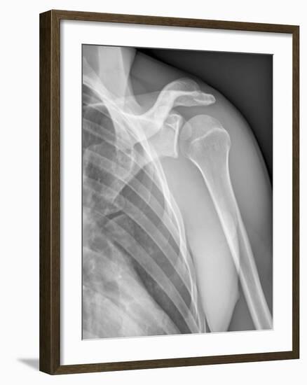 Normal Shoulder, X-ray-ZEPHYR-Framed Photographic Print