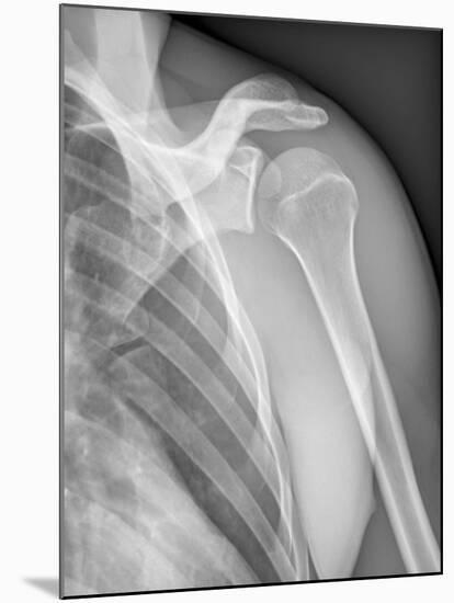 Normal Shoulder, X-ray-ZEPHYR-Mounted Photographic Print