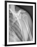 Normal Shoulder, X-ray-ZEPHYR-Framed Photographic Print