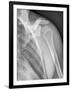 Normal Shoulder, X-ray-ZEPHYR-Framed Photographic Print