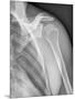 Normal Shoulder, X-ray-ZEPHYR-Mounted Photographic Print