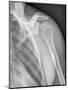 Normal Shoulder, X-ray-ZEPHYR-Mounted Premium Photographic Print