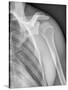 Normal Shoulder, X-ray-ZEPHYR-Stretched Canvas