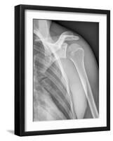 Normal Shoulder, X-ray-ZEPHYR-Framed Photographic Print