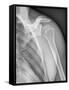 Normal Shoulder, X-ray-ZEPHYR-Framed Stretched Canvas