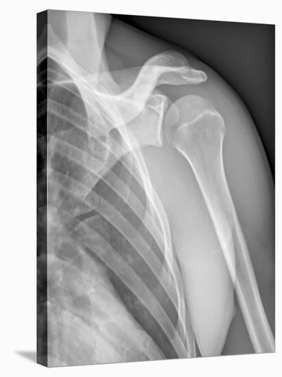 Normal Shoulder, X-ray-ZEPHYR-Stretched Canvas