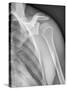 Normal Shoulder, X-ray-ZEPHYR-Stretched Canvas