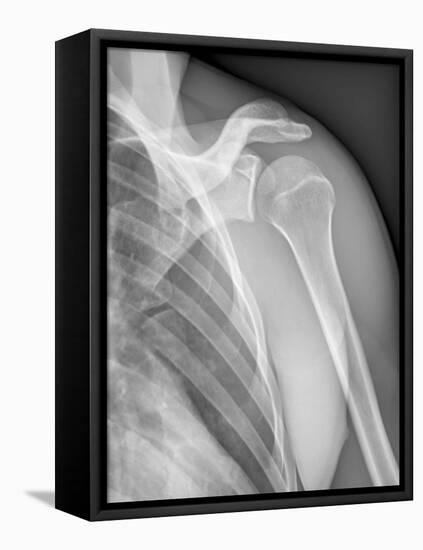 Normal Shoulder, X-ray-ZEPHYR-Framed Stretched Canvas