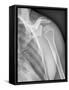 Normal Shoulder, X-ray-ZEPHYR-Framed Stretched Canvas