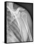 Normal Shoulder, X-ray-ZEPHYR-Framed Stretched Canvas