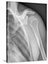Normal Shoulder, X-ray-ZEPHYR-Stretched Canvas