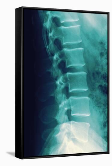 Normal Spine, X-ray-Miriam Maslo-Framed Stretched Canvas