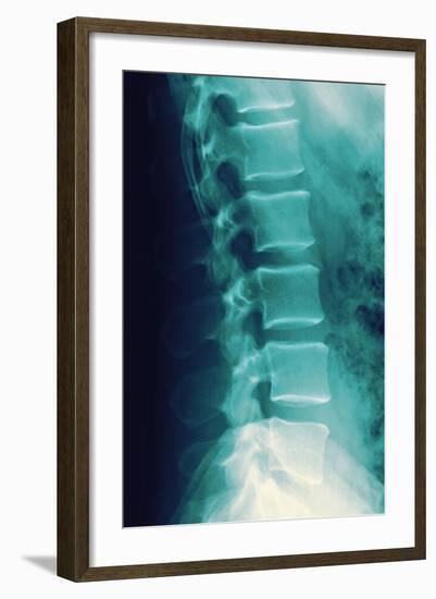 Normal Spine, X-ray-Miriam Maslo-Framed Premium Photographic Print