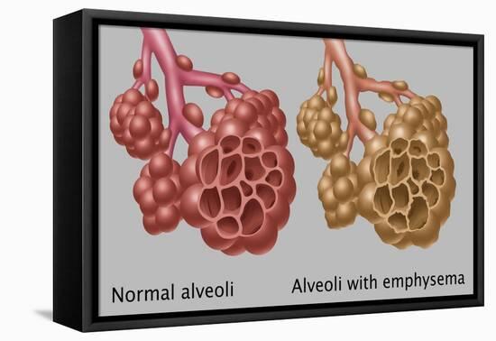 Normal vs. Emphysematous Alveoli-Gwen Shockey-Framed Stretched Canvas