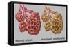 Normal vs. Emphysematous Alveoli-Gwen Shockey-Framed Stretched Canvas