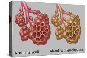 Normal vs. Emphysematous Alveoli-Gwen Shockey-Stretched Canvas