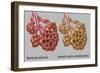 Normal vs. Emphysematous Alveoli-Gwen Shockey-Framed Giclee Print