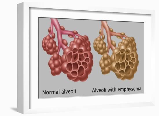 Normal vs. Emphysematous Alveoli-Gwen Shockey-Framed Giclee Print