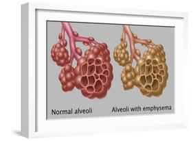 Normal vs. Emphysematous Alveoli-Gwen Shockey-Framed Giclee Print