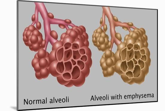 Normal vs. Emphysematous Alveoli-Gwen Shockey-Mounted Giclee Print