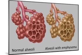 Normal vs. Emphysematous Alveoli-Gwen Shockey-Mounted Giclee Print