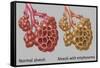 Normal vs. Emphysematous Alveoli-Gwen Shockey-Framed Stretched Canvas