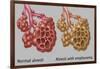 Normal vs. Emphysematous Alveoli-Gwen Shockey-Framed Giclee Print