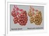 Normal vs. Emphysematous Alveoli-Gwen Shockey-Framed Giclee Print