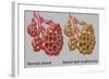 Normal vs. Emphysematous Alveoli-Gwen Shockey-Framed Giclee Print