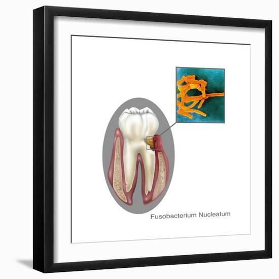 Oral Infection of Fusobacterium Nucleatum-Gwen Shockey-Framed Art Print