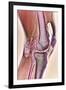 Osteoarthritic Knee X-ray-null-Framed Photographic Print