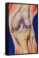 Osteoarthritic Knee-John Bavosi-Framed Stretched Canvas