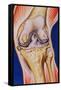 Osteoarthritic Knee-John Bavosi-Framed Stretched Canvas