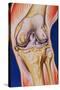 Osteoarthritic Knee-John Bavosi-Stretched Canvas