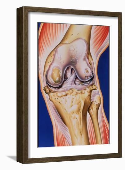 Osteoarthritic Knee-John Bavosi-Framed Photographic Print