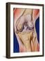 Osteoarthritic Knee-John Bavosi-Framed Photographic Print