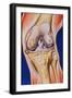 Osteoarthritic Knee-John Bavosi-Framed Photographic Print