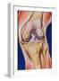 Osteoarthritic Knee-John Bavosi-Framed Photographic Print