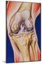 Osteoarthritic Knee-John Bavosi-Mounted Photographic Print