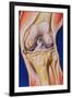 Osteoarthritic Knee-John Bavosi-Framed Photographic Print